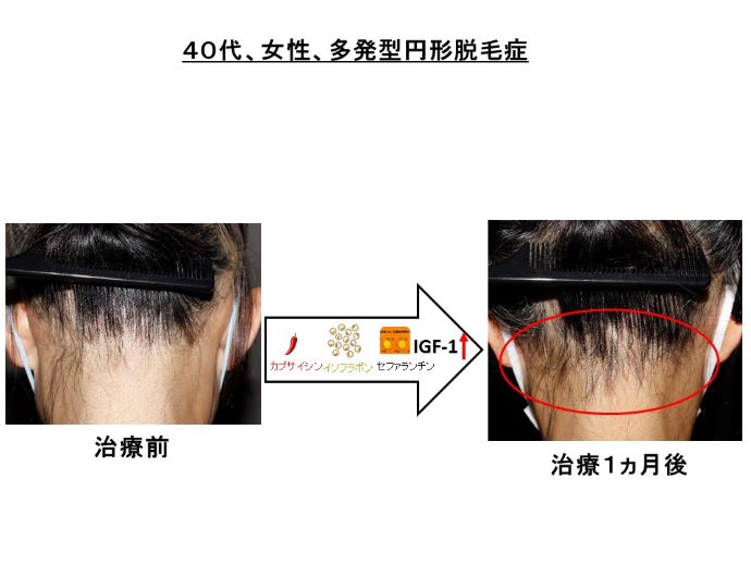 円形脱毛症　病院